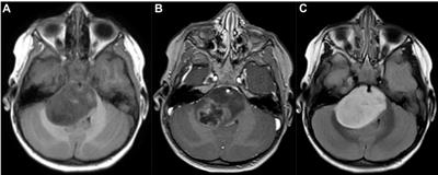 Brainstem tumors in children: a monocentric series in the light of genetic and bio-molecular progress in pediatric neuro-oncology